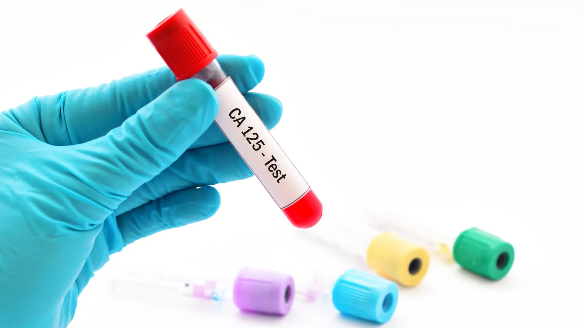 CA 125